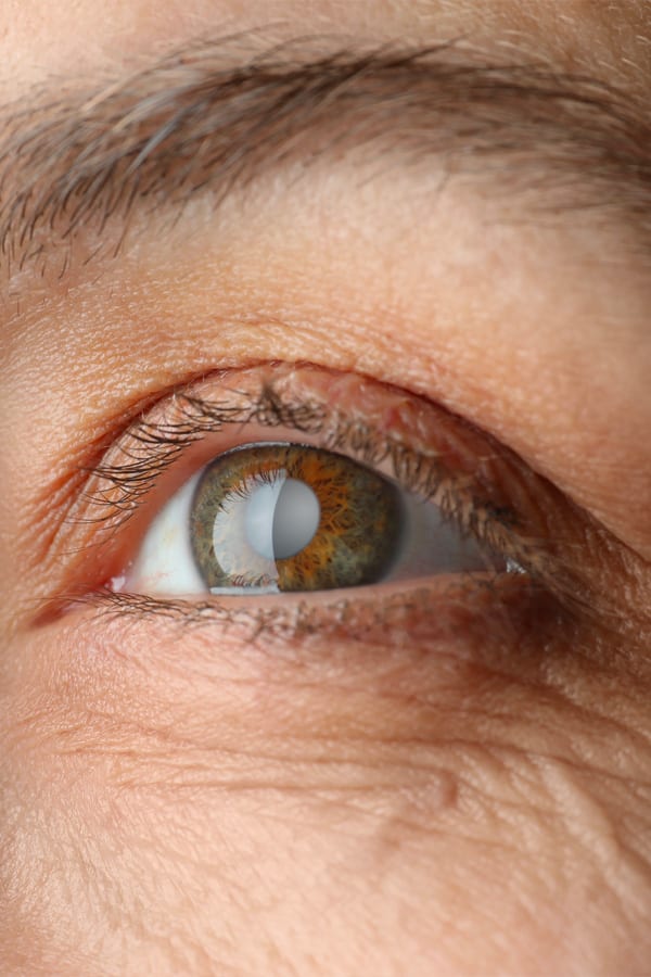 cataracte operation duree operation yeux laser antony 92 docteur godefroy kaswin ophtalmologue specialiste chirurgie refractive cataracte