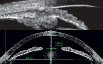 Échographie du segment antérieur (UBM) : indications et interprétation